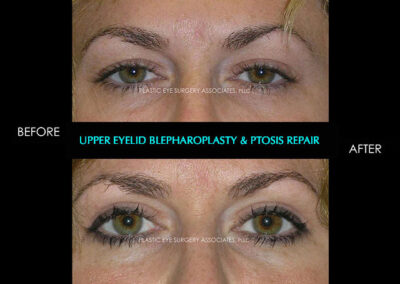 Female Blepharoplasty Photos 102