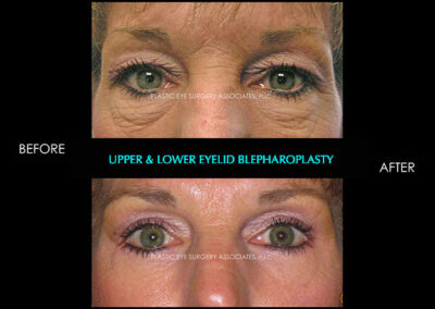 Female Blepharoplasty Photos 98