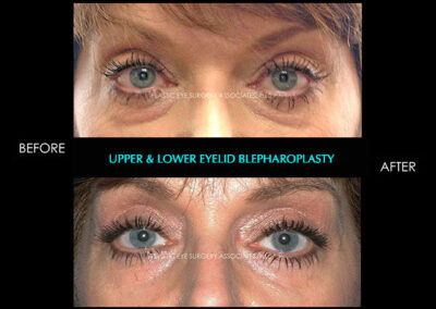 Eyelid Reshaping Photos 82