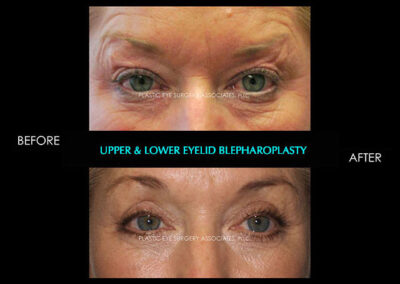 Eyelid Reshaping Photos 87