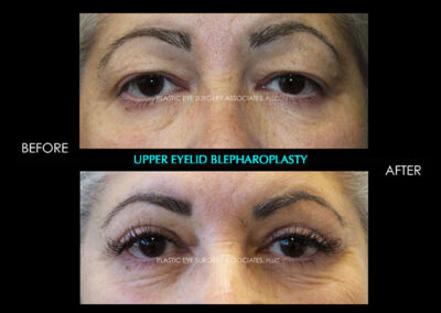 Eyelid Reshaping Photos 90