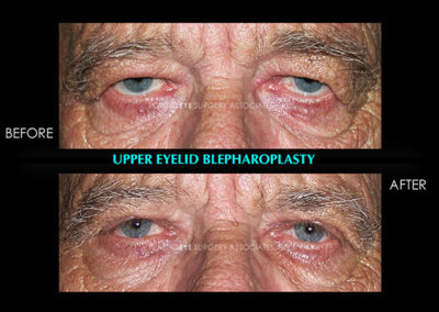 Eyelid Reshaping Photos 91