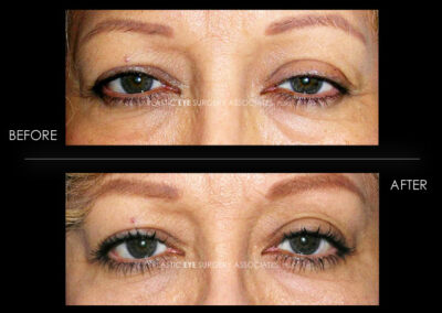 Ptosis (Droopy Eyelid) Photos 65