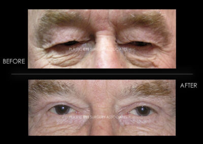Ptosis (Droopy Eyelid) Photos 73