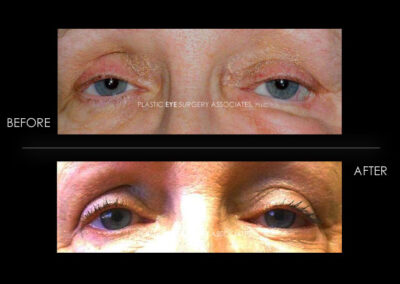 Ptosis (Droopy Eyelid) Photos 7