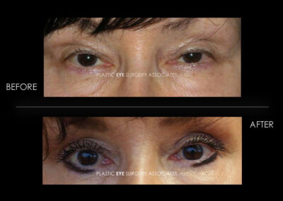 Ptosis (Droopy Eyelid) Photos 12