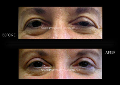 Ptosis (Droopy Eyelid) Photos 16