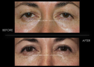 Ptosis (Droopy Eyelid) Photos 38