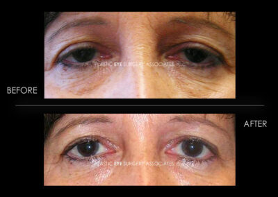 Ptosis (Droopy Eyelid) Photos 39