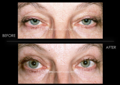 Ptosis (Droopy Eyelid) Photos 41