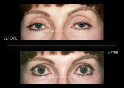 Ptosis (Droopy Eyelid) Photos 42
