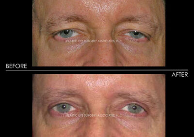 Ptosis (Droopy Eyelid) Photos 55