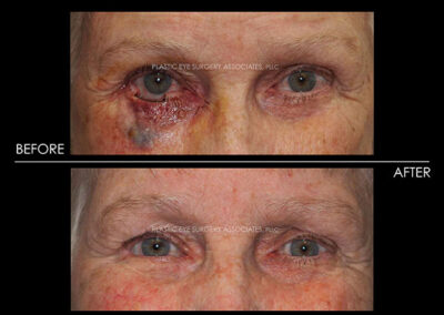 Eyelid Skin Cancer Reconstruction Photos 15