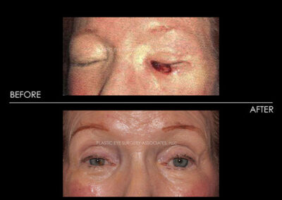 Eyelid Skin Cancer Reconstruction Photos 16