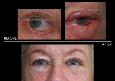 Eyelid Skin Cancer Reconstruction Photos 17