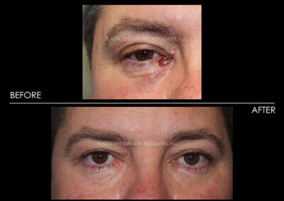 Eyelid Skin Cancer Reconstruction Photos 18