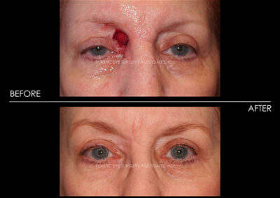 Eyelid Skin Cancer Reconstruction Photos 19