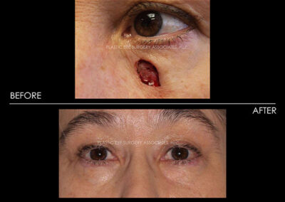 Eyelid Skin Cancer Reconstruction Photos 21