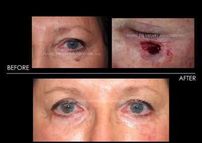 Eyelid Skin Cancer Reconstruction Photos 22
