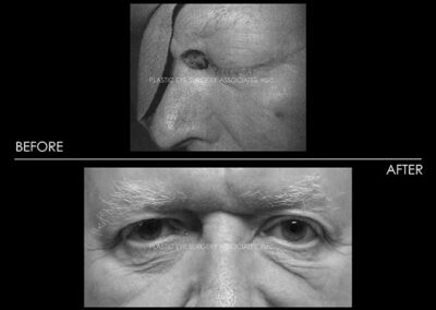 Eyelid Skin Cancer Reconstruction Photos 23
