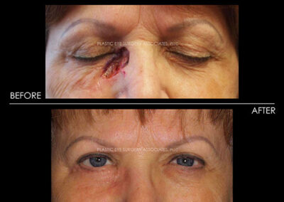 Eyelid Skin Cancer Reconstruction Photos 24