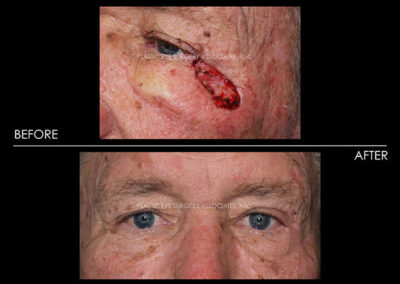 Eyelid Skin Cancer Reconstruction Photos 25