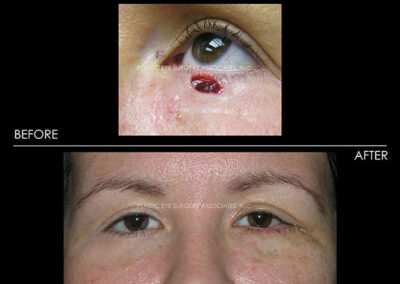 Eyelid Skin Cancer Reconstruction Photos 26