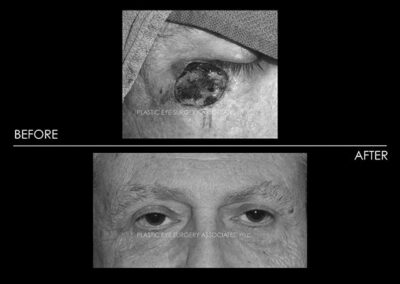 Eyelid Skin Cancer Reconstruction Photos 28