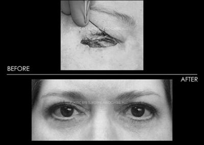 Eyelid Skin Cancer Reconstruction Photos 29