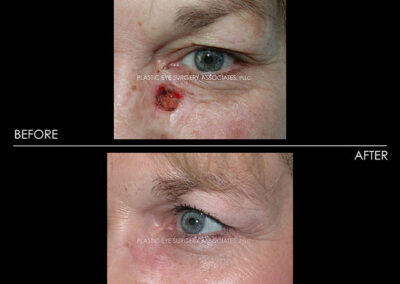 Eyelid Skin Cancer Reconstruction Photos 30