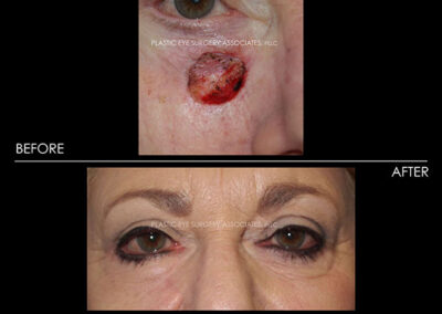 Eyelid Skin Cancer Reconstruction Photos 32