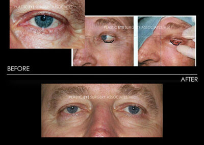 Eyelid Skin Cancer Reconstruction Photos 33