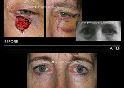 Eyelid Skin Cancer Reconstruction Photos 34