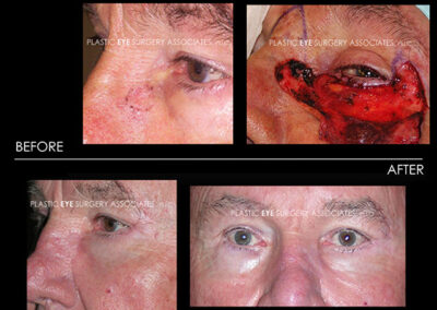 Eyelid Skin Cancer Reconstruction Photos 35