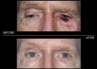 Eyelid Skin Cancer Reconstruction Photos 36