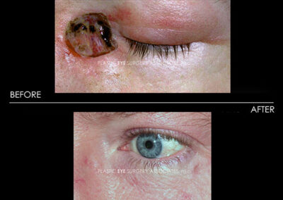 Eyelid Skin Cancer Reconstruction Photos 37