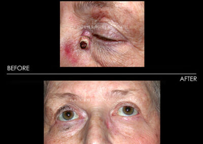 Eyelid Skin Cancer Reconstruction Photos 38