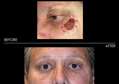 Eyelid Skin Cancer Reconstruction Photos 39