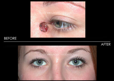 Eyelid Skin Cancer Reconstruction Photos 40