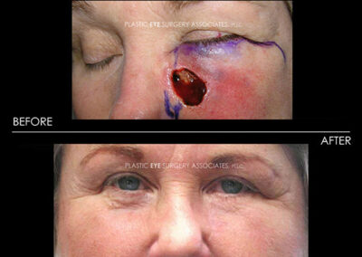 Eyelid Skin Cancer Reconstruction Photos 41
