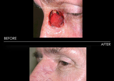 Eyelid Skin Cancer Reconstruction Photos 42
