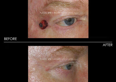 Eyelid Skin Cancer Reconstruction Photos 43