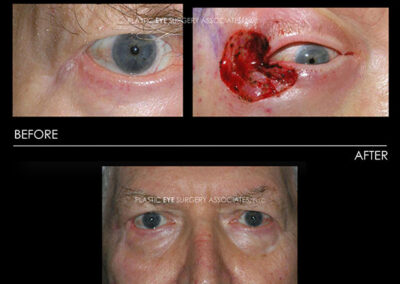 Eyelid Skin Cancer Reconstruction Photos 1
