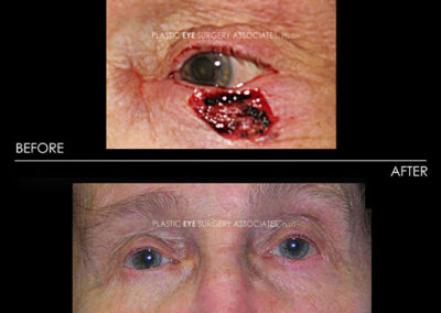 Eyelid Skin Cancer Reconstruction Photos 2