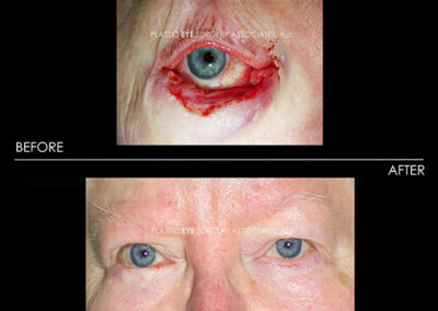 Eyelid Skin Cancer Reconstruction Photos 3