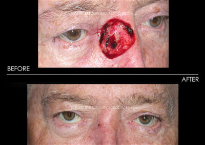 Eyelid Skin Cancer Reconstruction Photos 4