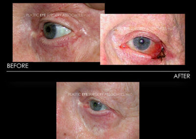 Eyelid Skin Cancer Reconstruction Photos 5