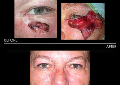Eyelid Skin Cancer Reconstruction Photos 6