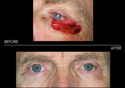 Eyelid Skin Cancer Reconstruction Photos 7