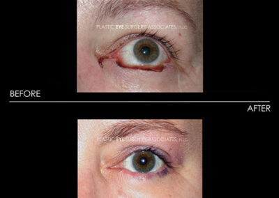 Eyelid Skin Cancer Reconstruction Photos 8